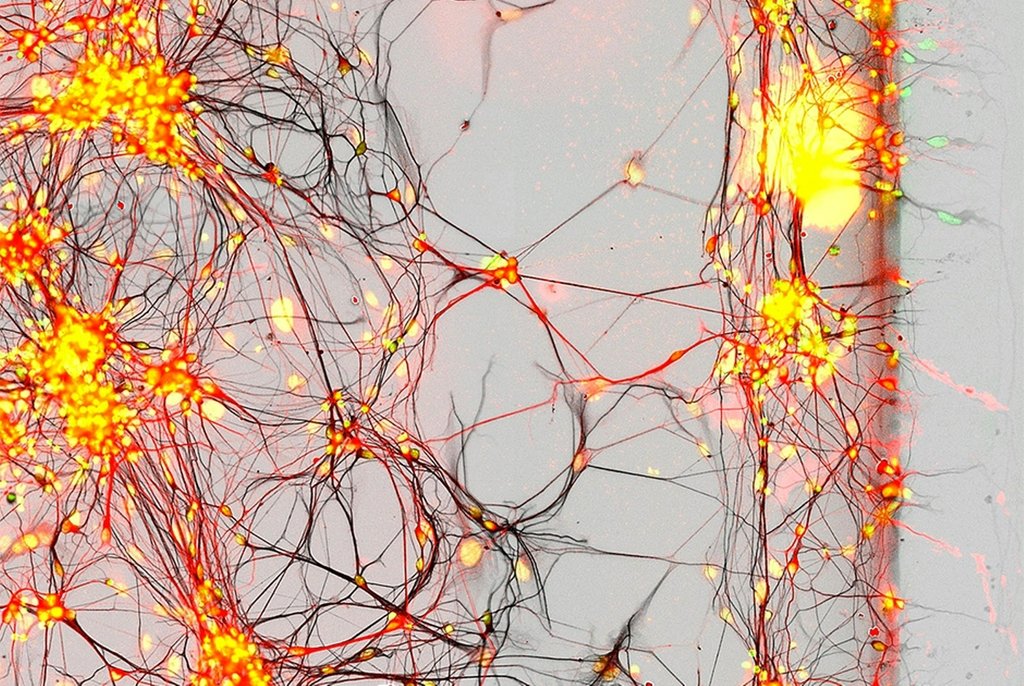 Человеческие нейроны в культуре клеток, выделенных у пациентов с болезнью Паркинсона. Соннам, Южная Корея. Фото Dr. Regis Grailhe, Nasia Antoniou, Dr. Rebecca Matsas(...из интернета) 